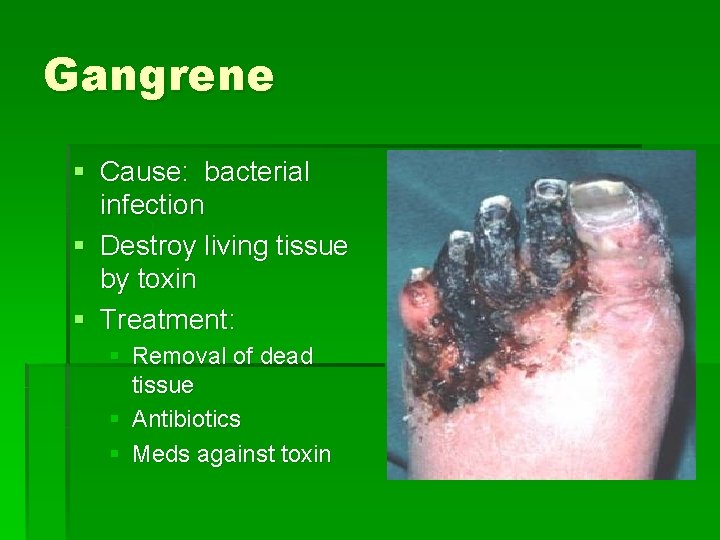 Gangrene § Cause: bacterial infection § Destroy living tissue by toxin § Treatment: §