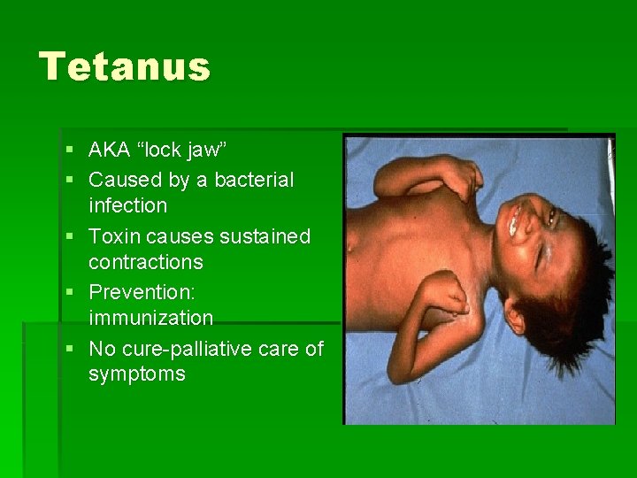 Tetanus § AKA “lock jaw” § Caused by a bacterial infection § Toxin causes