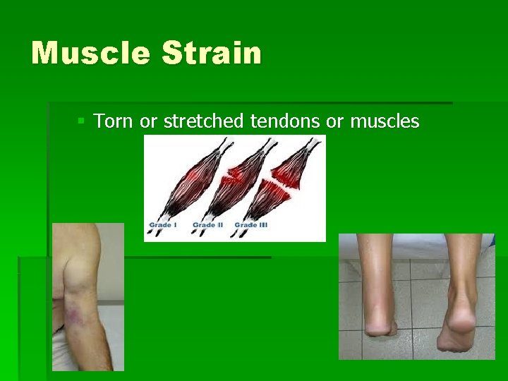 Muscle Strain § Torn or stretched tendons or muscles 