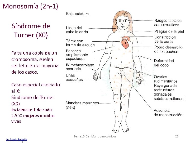 Monosomía (2 n-1) Síndrome de Turner (X 0) Falta una copia de un cromosoma,