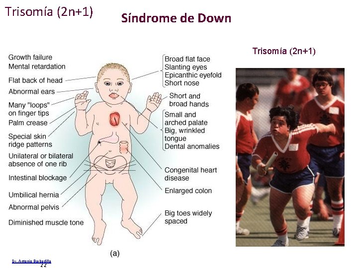 Trisomía (2 n+1) Síndrome de Down Trisomía (2 n+1) 22 Dr. Antonio Barbadilla 22