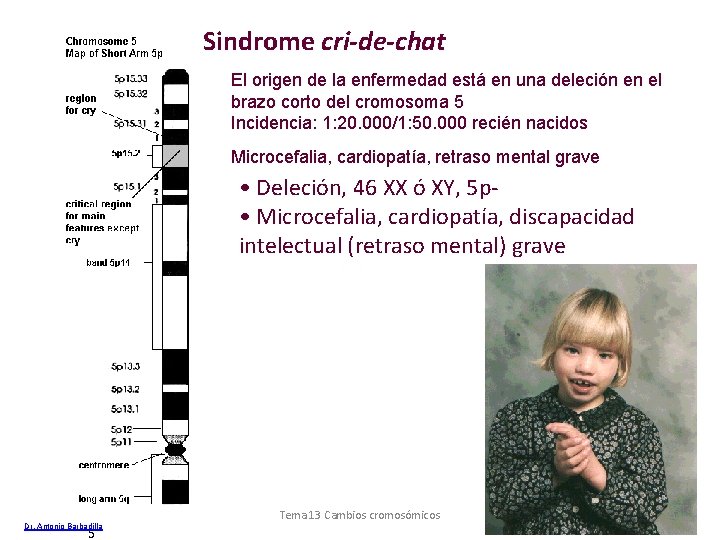 Sindrome cri-de-chat El origen de la enfermedad está en una deleción en el brazo