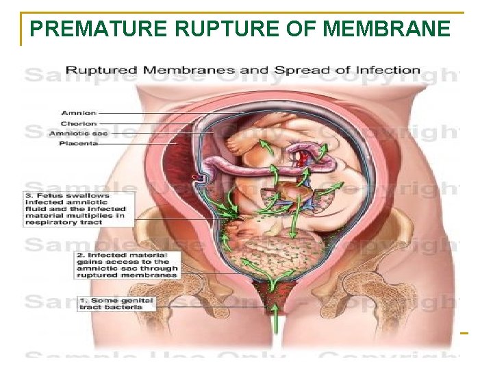 PREMATURE RUPTURE OF MEMBRANE 