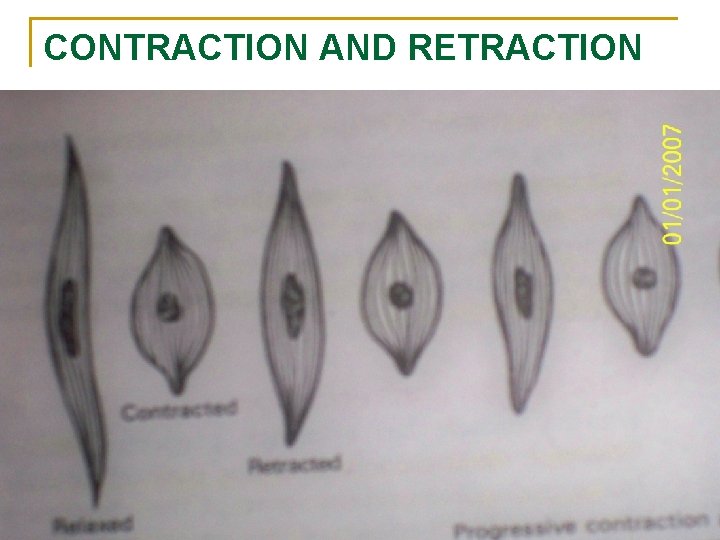 CONTRACTION AND RETRACTION 