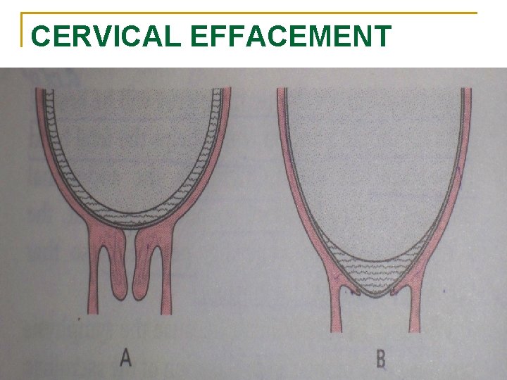 CERVICAL EFFACEMENT 