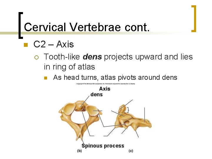 Cervical Vertebrae cont. n C 2 – Axis ¡ Tooth-like dens projects upward and