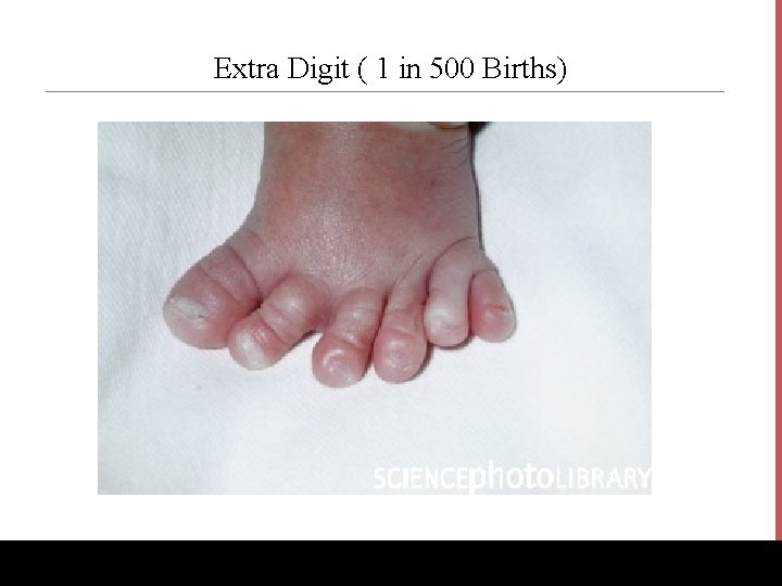 Extra Digit ( 1 in 500 Births) www. Bio. Ed. Online. org 