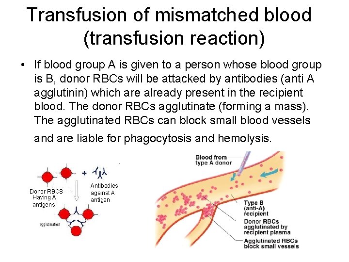 Transfusion of mismatched blood (transfusion reaction) • If blood group A is given to