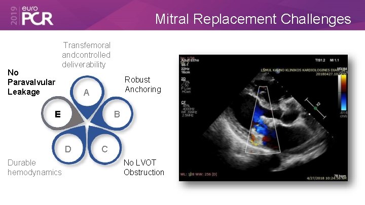 Mitral Replacement Challenges No Paravalvular Leakage Transfemoral and controlled deliverability Robust Anchoring A E