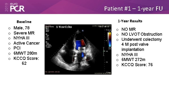 Patient #1 – 1 -year FU o o o o Baseline Male, 78 Severe
