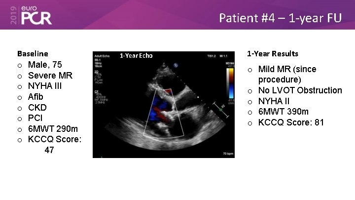 Patient #4 – 1 -year FU Baseline o Male, 75 o Severe MR o