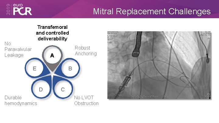 Mitral Replacement Challenges No Paravalvular Leakage Transfemoral and controlled deliverability Robust Anchoring A E