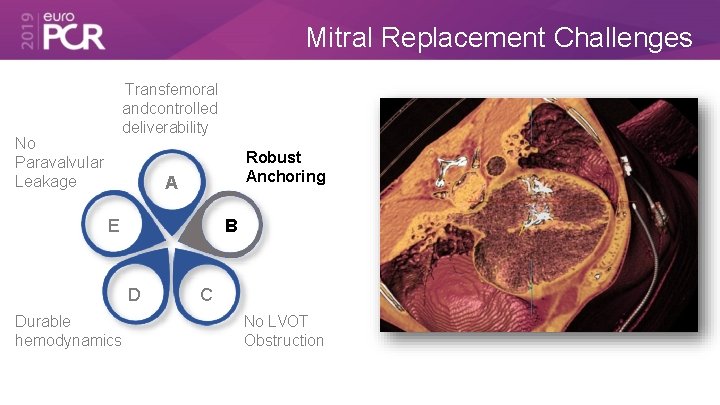 Mitral Replacement Challenges Transfemoral and controlled deliverability No Paravalvular Leakage Robust Anchoring A E