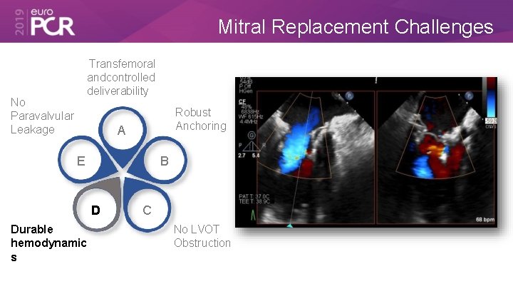 Mitral Replacement Challenges Transfemoral and controlled deliverability No Paravalvular Leakage Robust Anchoring A E