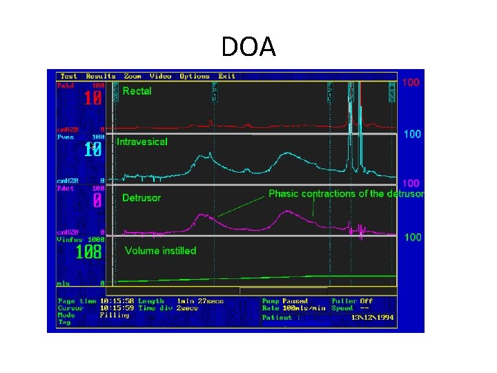 DOA DOA