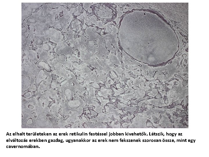 Az elhalt területeken az erek retikulin festéssel jobban kivehetők. Látszik, hogy az elváltozás erekben