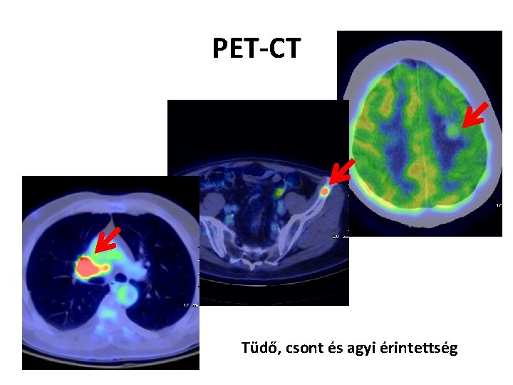 PET-CT Tüdő, csont és agyi érintettség 