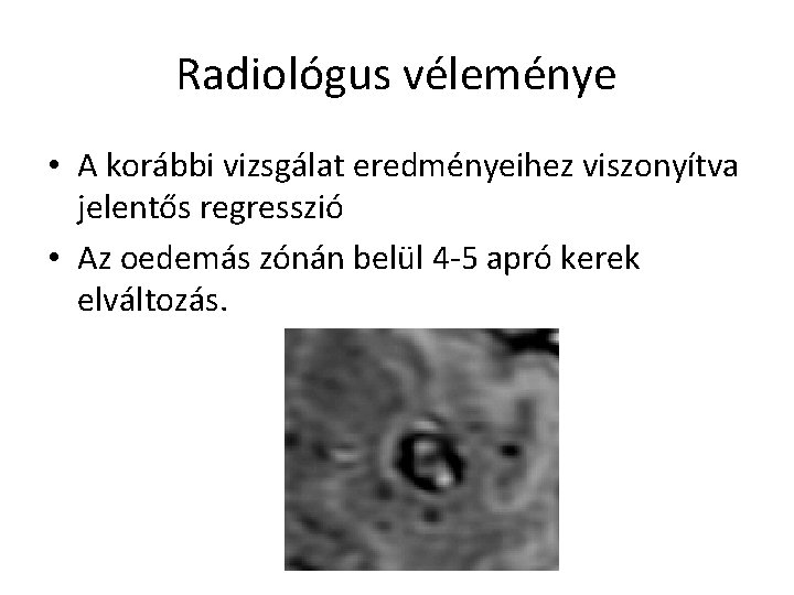 Radiológus véleménye • A korábbi vizsgálat eredményeihez viszonyítva jelentős regresszió • Az oedemás zónán