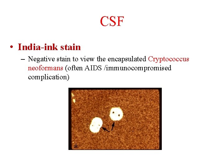 CSF • India-ink stain – Negative stain to view the encapsulated Cryptococcus neoformans (often