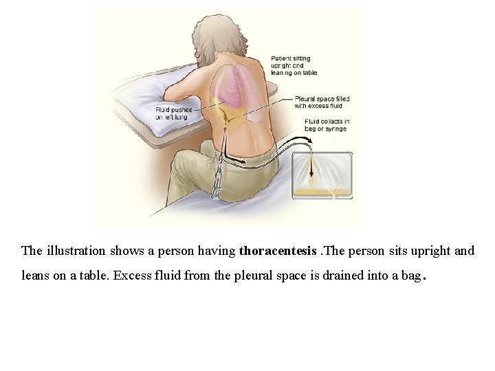 The illustration shows a person having thoracentesis. The person sits upright and leans on