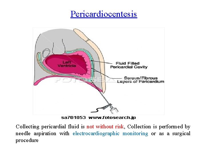 Pericardiocentesis Collecting pericardial fluid is not without risk, Collection is performed by needle aspiration