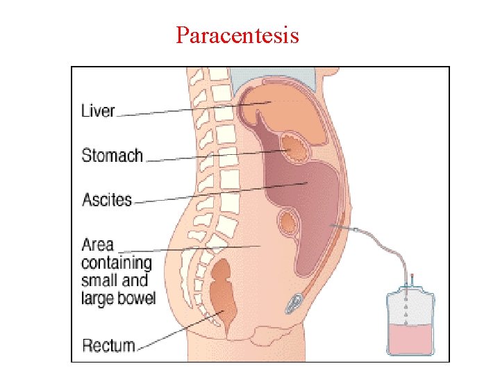 Paracentesis 