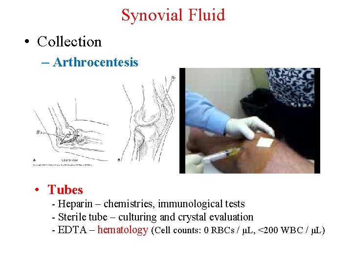 Synovial Fluid • Collection – Arthrocentesis • Tubes - Heparin – chemistries, immunological tests