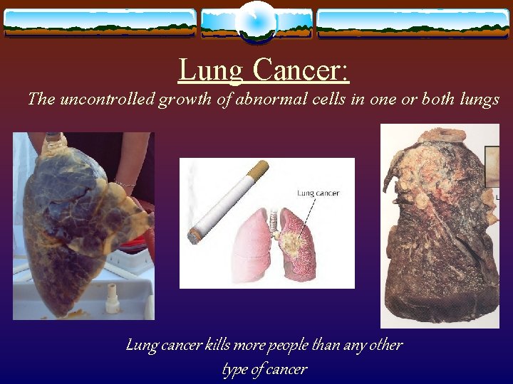 Lung Cancer: The uncontrolled growth of abnormal cells in one or both lungs Lung