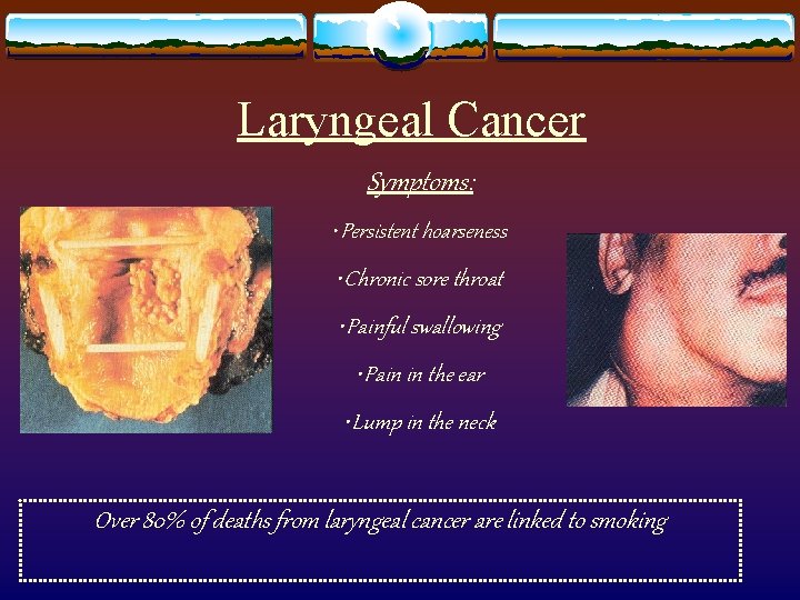 Laryngeal Cancer Symptoms: • Persistent hoarseness • Chronic sore throat • Painful swallowing •