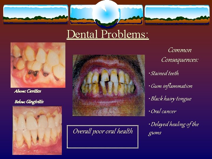 Dental Problems: Common Consequences: • Stained teeth • Gum inflammation Above: Cavities • Black