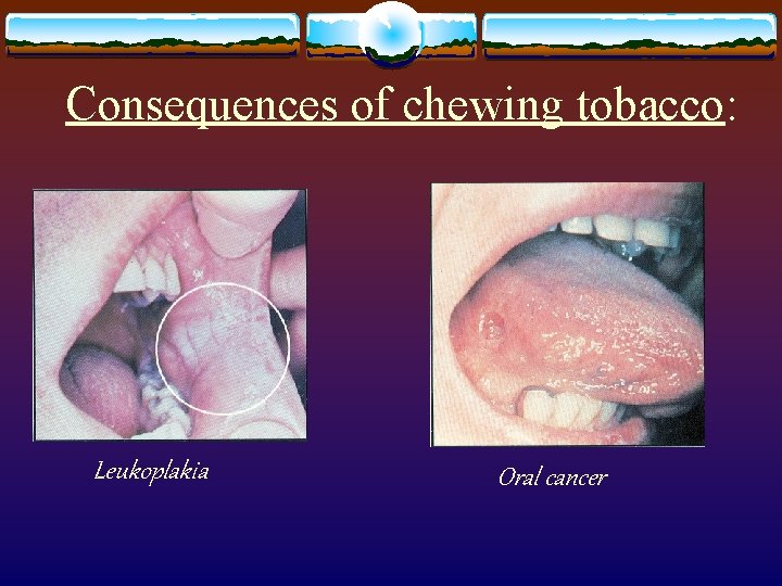 Consequences of chewing tobacco: Leukoplakia Oral cancer 