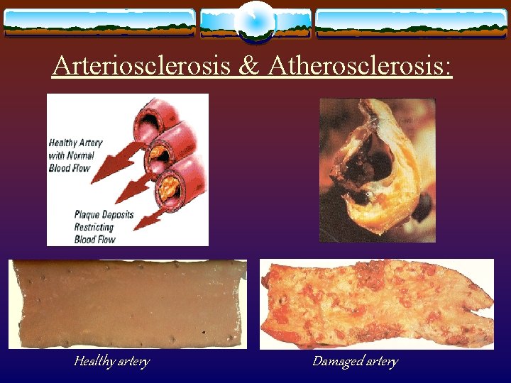 Arteriosclerosis & Atherosclerosis: Healthy artery Damaged artery 