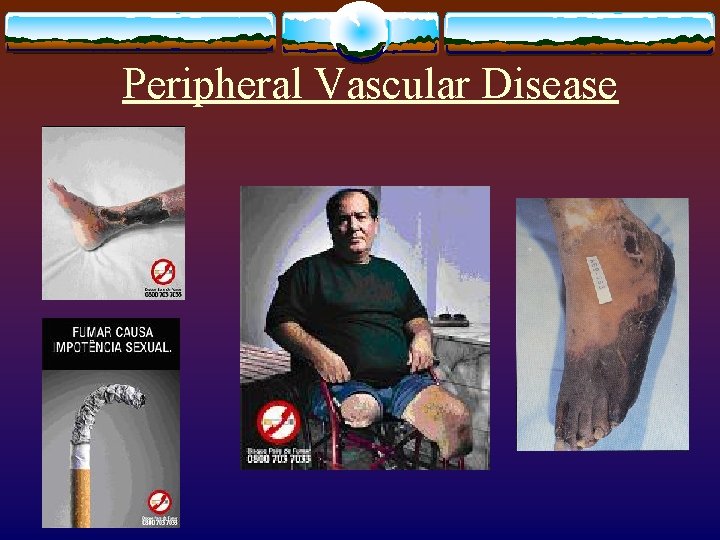 Peripheral Vascular Disease 