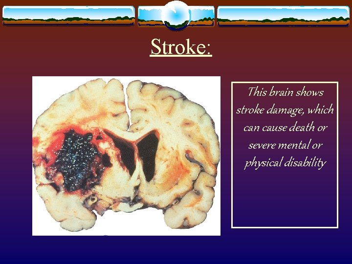 Stroke: This brain shows stroke damage, which can cause death or severe mental or