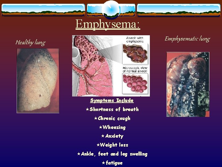 Emphysema: Emphysematic lung Healthy lung Symptoms Include «Shortness of breath «Chronic cough «Wheezing «Anxiety