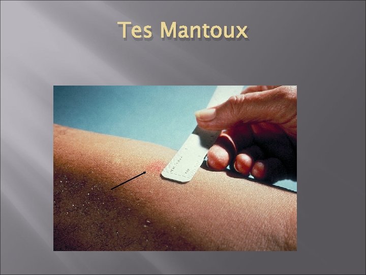 Tes Mantoux 