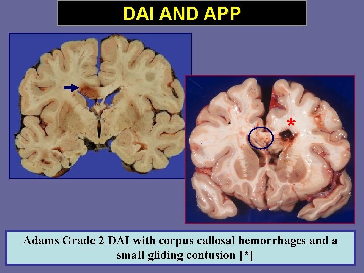 DAI AND APP * Adams Grade 2 DAI with corpus callosal hemorrhages and a