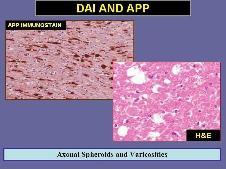 DAI AND APP IMMUNOSTAIN H&E Axonal Spheroids and Varicosities 