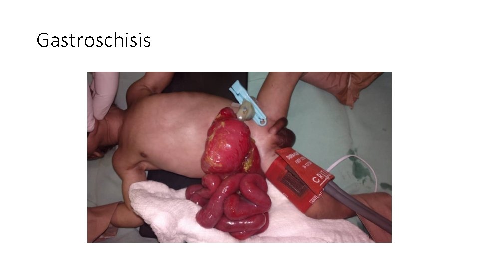 Gastroschisis 