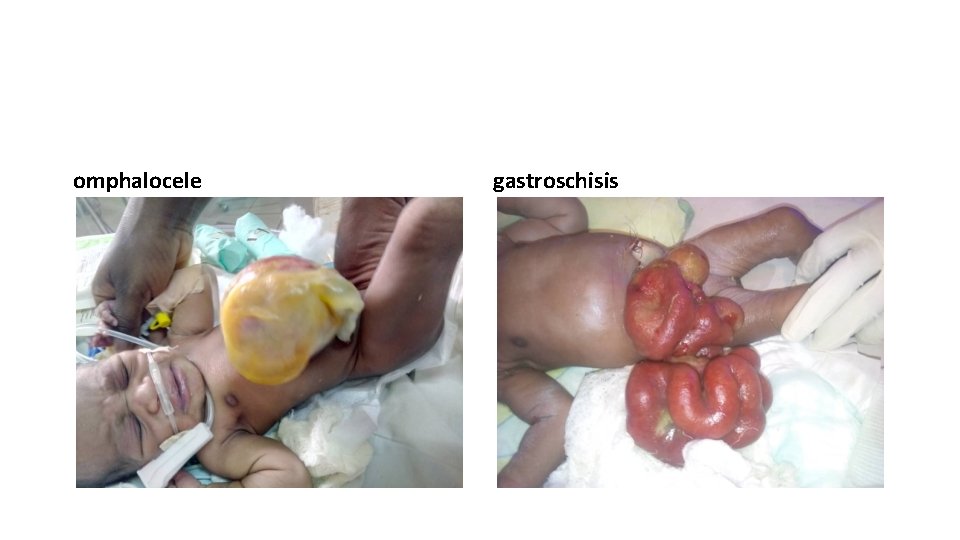 omphalocele gastroschisis 