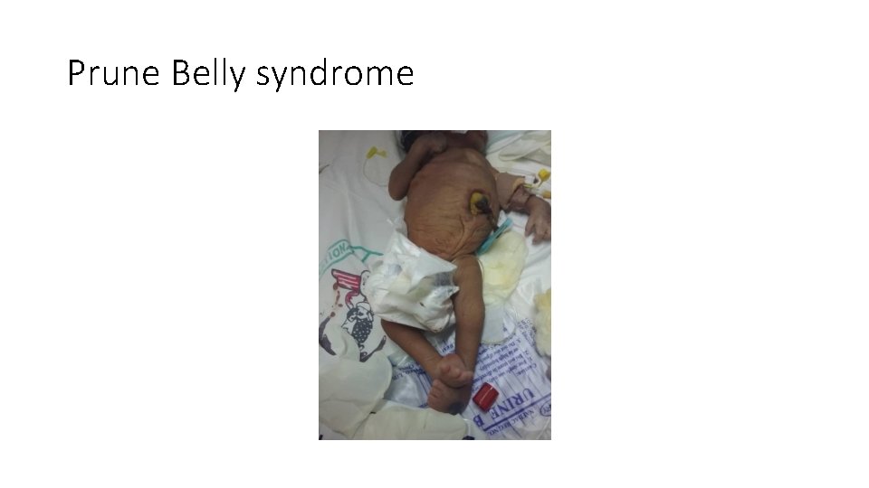 Prune Belly syndrome 