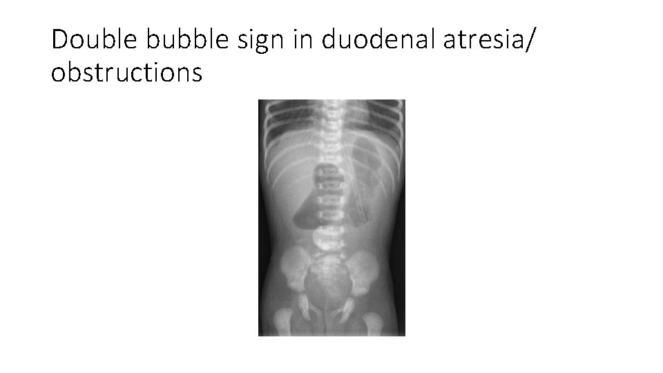 Double bubble sign in duodenal atresia/ obstructions 