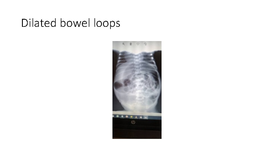 Dilated bowel loops 