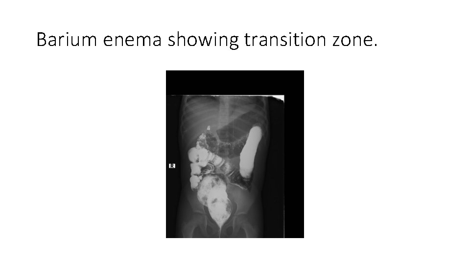 Barium enema showing transition zone. 