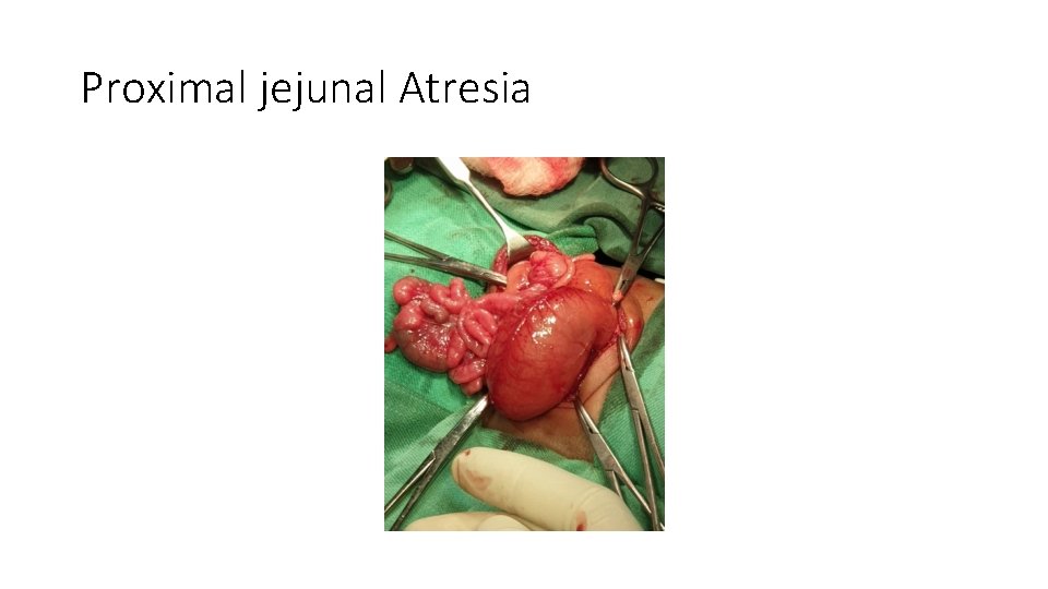 Proximal jejunal Atresia 