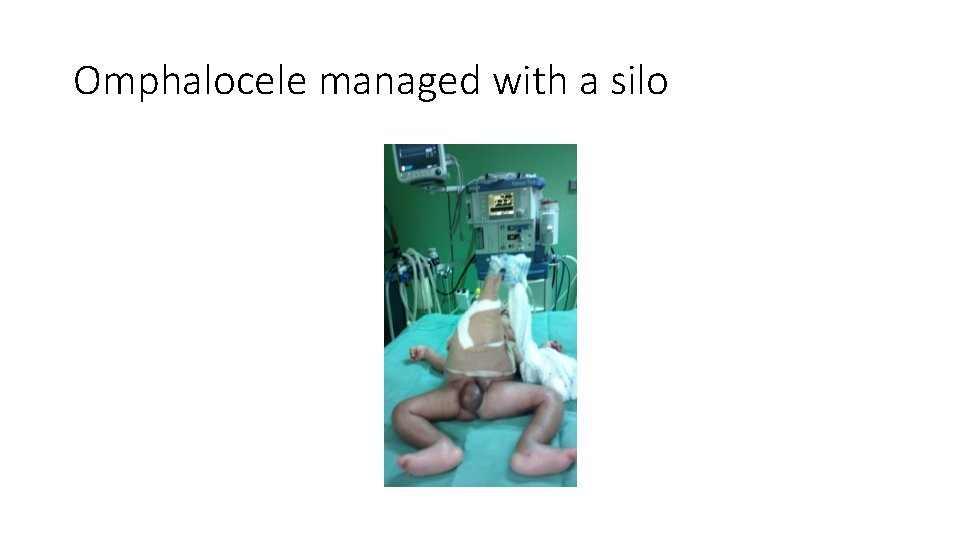 Omphalocele managed with a silo 