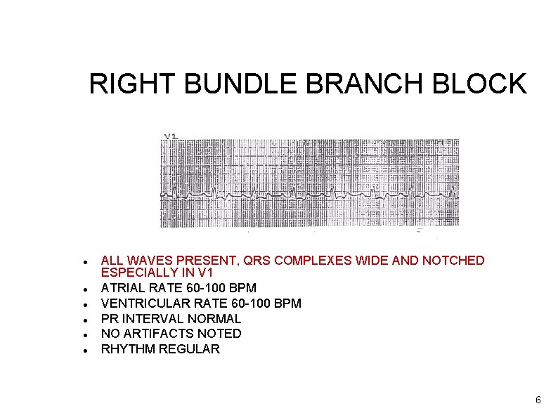 RIGHT BUNDLE BRANCH BLOCK ALL WAVES PRESENT, QRS COMPLEXES WIDE AND NOTCHED ESPECIALLY IN
