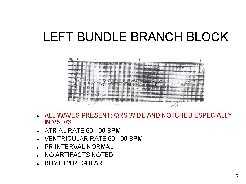 LEFT BUNDLE BRANCH BLOCK ALL WAVES PRESENT; QRS WIDE AND NOTCHED ESPECIALLY IN V