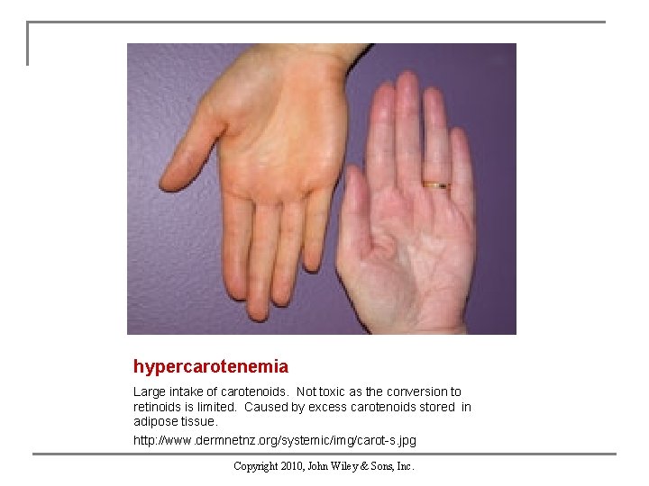 hypercarotenemia Large intake of carotenoids. Not toxic as the conversion to retinoids is limited.