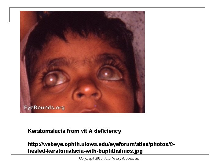 Keratomalacia from vit A deficiency http: //webeye. ophth. uiowa. edu/eyeforum/atlas/photos/8 healed-keratomalacia-with-buphthalmos. jpg Copyright 2010,